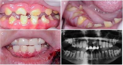 Case Report: Crown Resorption in a Patient With Junctional Epidermolysis Bullosa and Amelogenesis Imperfecta With LAMB3 Gene Mutations